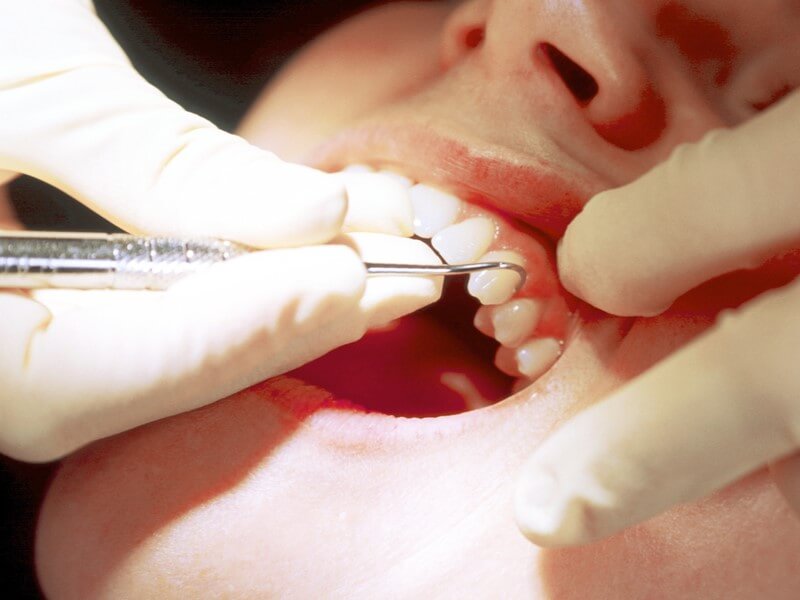 歯周病は、歯を失う原因の第一位
